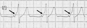 Anomalía electrocardiográfica de WPW. Se observa un PR corto y un ensanchamiento del QRS por la presencia de un empastamiento inicial, la onda delta (flecha). Ver explicación en texto.