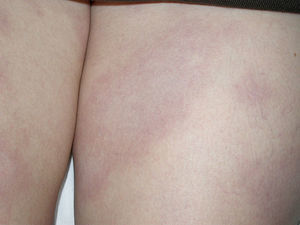 Placa eritematoviolácea, con mínima descamación furfurácea en la superficie de las piernas.