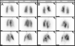 A) Gammagrafía de ventilación que mostró un estudio de ventilación normal. B) Gammagrafía de perfusión con múltiples defectos de perfusión intrapulmonares en el pulmón izquierdo.