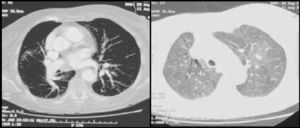 Angiotomografía computarizada torácica, en la que se aprecia una «perfusión en mosaico» en el parénquima pulmonar, sin evidencia de defectos de repleción en las arterias pulmonares o sus ramas y divisiones segmentarias que sugieran tromboembolismo pulmonar.