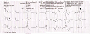ECG. Onda J de Osborn (flechas).