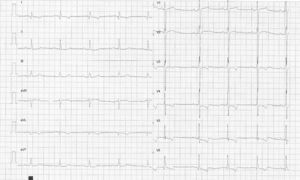 Electrocardiograma característico de hipertrofia de ventrículo izquierdo significativa con patrón de sobrecarga sistólica.