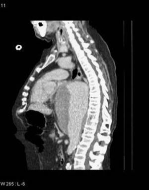 Corte sagital de la tomografía toracoabdominal