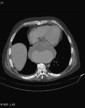 Angiotomografía de arterias pulmonares (ATC).