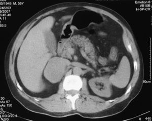 TC abdominal: masa adrenal derecha de 6cm.