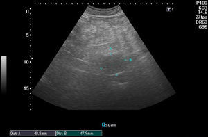 Medición ecográfica de diámetro de aneurisma de aorta abdominal.