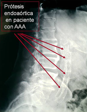 Imagen radiográfica de prótesis endoaórtica en paciente con aneurisma de aorta abdominal.