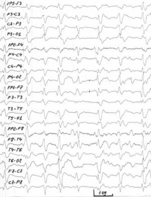 Registro de EEG en la enfermedad de Creutzfeldt-Jakob. (http://neurologia.rediris.es/congreso-1/conferencias/imagenes/priones-9-3.jpg).