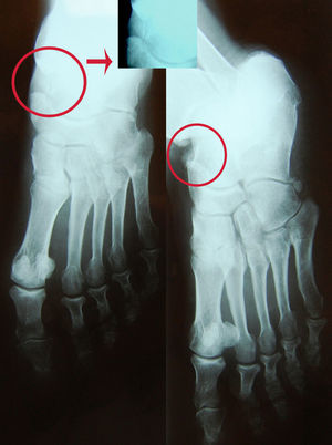 Radiografía simple inicial del pie. Círculos rojos: imagen sospechosa de fractura que corresponde a hueso accesorio os tibiale. Flecha: ampliación del hueso os tibiale.