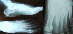Radiografía simple de pie a las 6 y 9 semanas. A: Círculo rojo: Fractura de diáfisis de segundo metatarsiano en dos proyecciones. B: Imagen de callo de fractura.