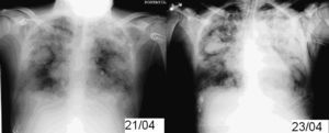 Radiografía de tórax en la que se observa patrón intersticial alveolar y nódulos alveolares.