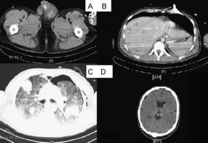 Imágenes TAC. A) Corte pélvico apreciándose masa escrotal. B) Corte abdominal con metástasis hepáticas. C) Corte torácico apreciándose metástasis pulmonares. D) Corte cerebral apreciándose metástasis cerebrales.