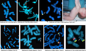 Figuras de FISH mostrando diferentes síndromes de microdeleción. Las flechas indican el cromosoma donde se ha perdido la señal y por tanto ese fragmento. La foto clínica muestra la hipotonía del síndrome de Prader-Willi.