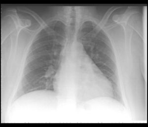 Radiografía de tórax: cardiomegalia. Poco inspirada.