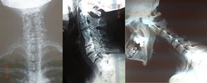 Radiología de columna cervical.