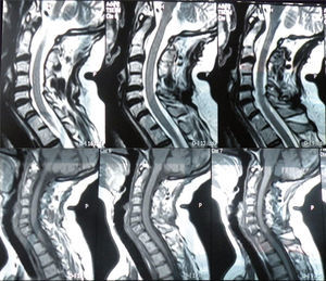 RMN de columna cervical.