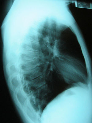 Radiografia de perfil de columna dorsal: nódulos de schmörl, irregularidades, erosiones en cuerpos vertebrales.