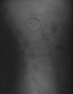 Radiografia de perfil de columna lumbar: depresión en la parte anterior del platillo vertebral de D12, L1 i L2.