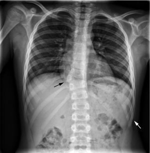 Imagen radiológica en proyección anteroposterior de parrilla costal bilateral. Se aprecia hemivértebra dorsal a nivel D10 con costilla adyacente ipsolateral derecha, con ausencia de cuerpo vertebral izquierdo así como de la costilla a ese nivel en el lado izquierdo (flecha negra). Existen 12 vértebras dorsales, la D10 incompleta, y 12 costillas en cada hemitórax, apareciendo en hemitórax izquierdo fusionadas las costillas 10 y 11 de ese lado (flecha blanca). Puede apreciarse también que no existe una curvatura dorsal importante, ya que la presencia de dicha hemivértebra se ve compensada en los niveles superiores e inferiores vertebrales para conseguir un buen alineamiento de los cuerpos vertebrales en su totalidad.