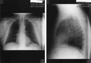 Radiografía de tórax. Se aprecia una silueta cardiaca conservada con un hilio izquierdo levemente aumentado.