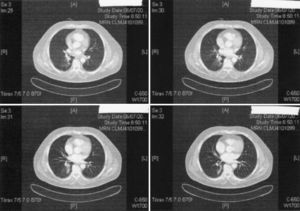 TAC torácica. Nódulo sólido adyacente a la pared posterior del bronquio intermediario que podría corresponder a una adenomegalia.