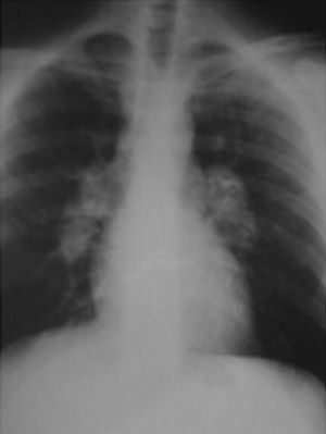 Radiografía de tórax donde se observa ensanchamiento mediastínico debido a un crecimiento muy acusado de ambos íleos pulmonares.