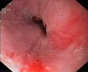 Estenosis esofágica distal de aspecto inflamatorio-fibrótico.