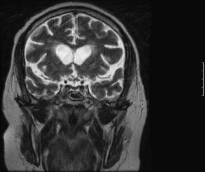 Corte Coronal T2 Hipófisis.