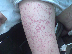 Lesiones eritematosas palpables con vitropresión negativa en extremidades inferiores.