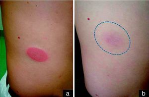a) Lesión típica de eritema fijo medicamentoso: placa ovaladas, eritemato-edematosas, bien delimitadas en abdomen tras la toma de ibuprofeno. b) Leve hiperpigmentación residual de varias semanas de duración que aparece en la misma localización donde estuvo la placa eritematosa aguda, y que da nombre a esta entidad (erythème pigmenté fixe).