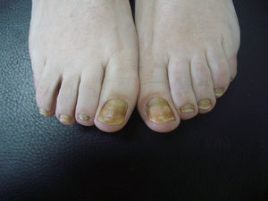 Uñas del pie. Pigmentación amarillenta de las 10 uñas de aparición simultánea.