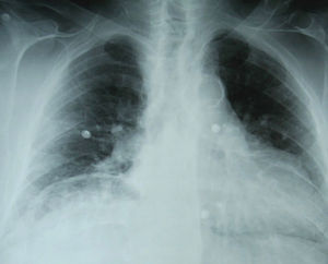Radiografía de tórax tomada al paciente en urgencias. Proyección anteroposterior.