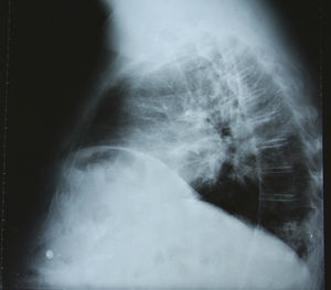 En la proyección lateral se pueden apreciar las haustras del colon.