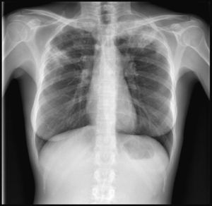 Prueba de la tuberculina negativa y en la radiografía de tórax infiltrados bilaterales en ambos lóbulos superiores, más acentuado en lóbulo superior izquierdo.