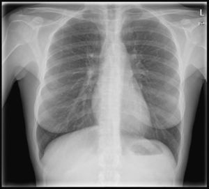 Desaparición de los infiltrados pulmonares y la eosinofilia periférica a las 3 semanas de tratamiento.