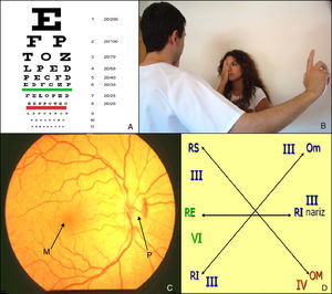 Exploración de pares craneales: óptico (II) y oculomotores (III, IV, VI): A) Tabla de Snellen. B) Campimetría por confrontación. C) Fondo de ojo. D) Exploración de la motilidad ocular extrínseca. M: mácula, Om: oblicuo menor, OM: oblicuo mayor; P: papila; RE: recto externo; RI: rector inferior; RS: recto superior.