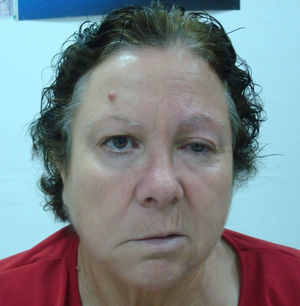 Parálisis facial periférica derecha.