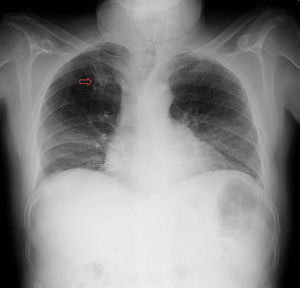 Radiografía de tórax PA.