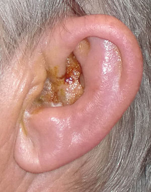 Se observan las lesiones ampollosas en pabellón auricular. (Fotografía propia; de 15 x 6cm, sensibilidad a 8 Pix).