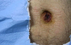 Metástasis umbilical (nódulo de la hermana María José).