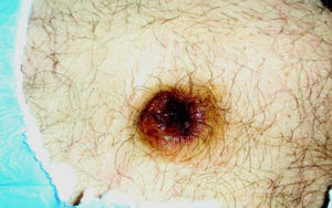 Metástasis umbilical (nódulo de la hermana María José).