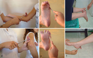 Exploración de los reflejos: A. Reflejo bicipital. B. Reflejo tricipital. C. Reflejo cutáneo plantar flexor (normal). D. Reflejo cutáneo plantar extensor (Babinski: patológico). E. Reflejo aquíleo arrodillado. F. Reflejo aquíleo sentado.