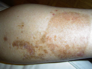 Lesiones cicatriciales residuales, de aspecto marronáceo y atrófico que ocupan gran superficie de las extremidades.