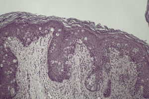 Células de Paget en epidermis. Presentan citoplasma claro y nucléolo prominente.