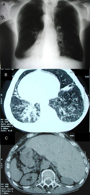 A) Radiografía de tórax: dextrocardia, cámara gástrica a la derecha, bronquiectasias. B) TC torácica: dextrocardia completa con arco aórtico y corazón a la derecha, bronquiectasias bibasales. C) TC abdominal: bazo a la derecha e hígado a la izquierda.