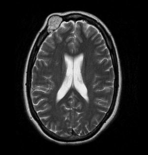 RMN cerebral.