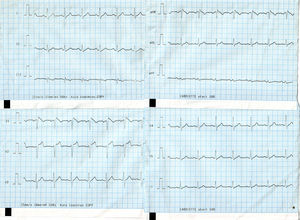 El electrocardiograma muestra un eje a 60°, ritmo sinusal, 42 lat./min, una elevación descendente del segmento ST de más de 2mm y onda T negativa de V1 a V3.