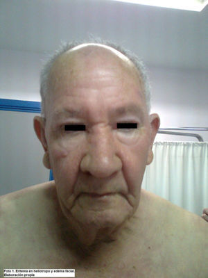 Dermatomiositis.