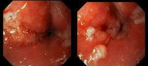 Esofagoscopía: neoformación estenosante en esófago a 20cm, compatible con carcinoma epidermoide de esófago estenosante.
