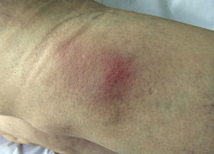 Eritema nudoso. Eritema nudoso en la cara posterior de la pierna izquierda de la paciente del caso A.